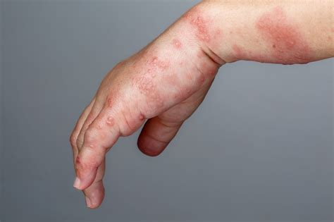 fotografie de tratament cu eczemă cu varicină